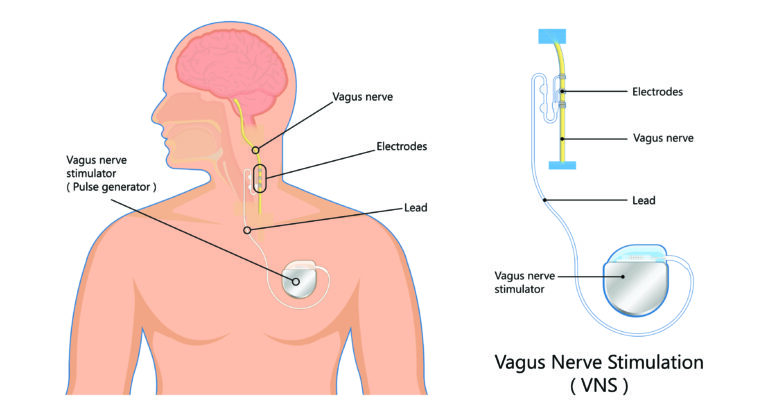 Vagal Nerve Stimulation